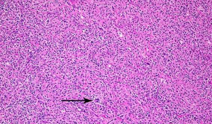 Hodgkins Blood Case Study [Robert O. Young, Ph.D., D.Sc.]